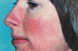 rosacea